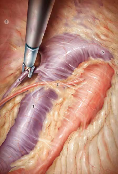 Sol renal V