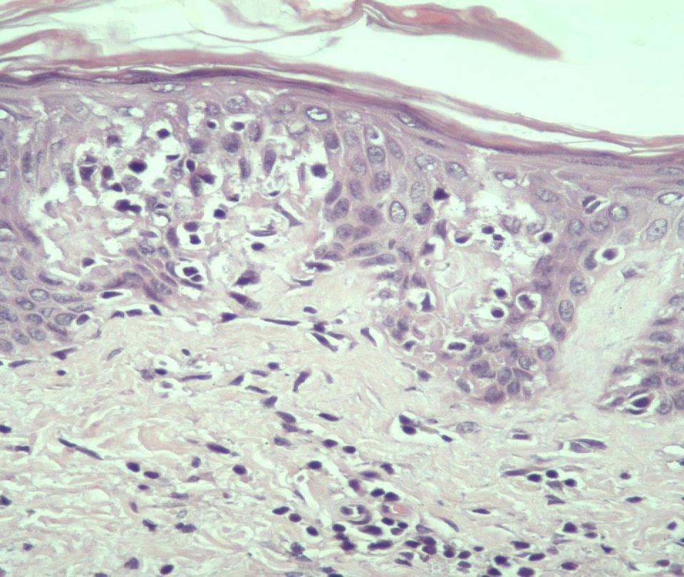 54 Şekil 4.4. DB-UVB öncesi epidermotropizm ve