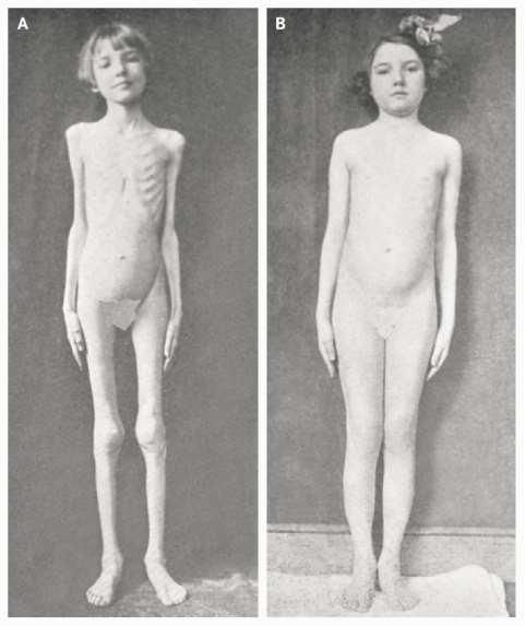 Tip 1 Diyabette İnsülin Tedavisi 1922