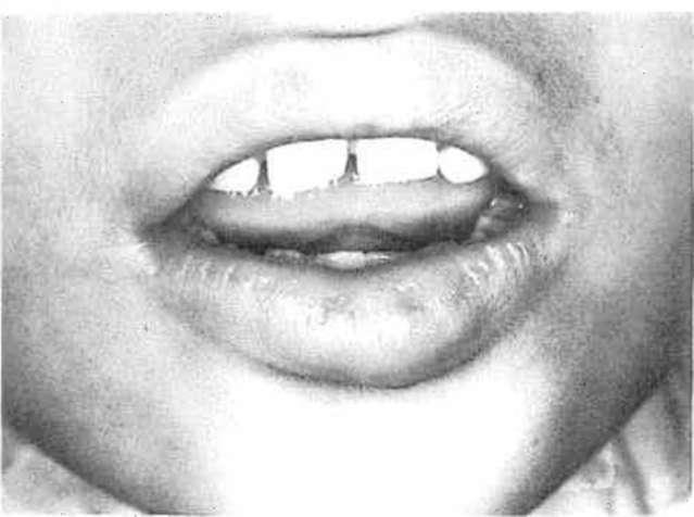 Bunlar; çarpmanın yönü, anterior dişlerin çıkıntılı olması ve yaralanma sırasında dudağın uzunluğu veya pozisyonudur (1).