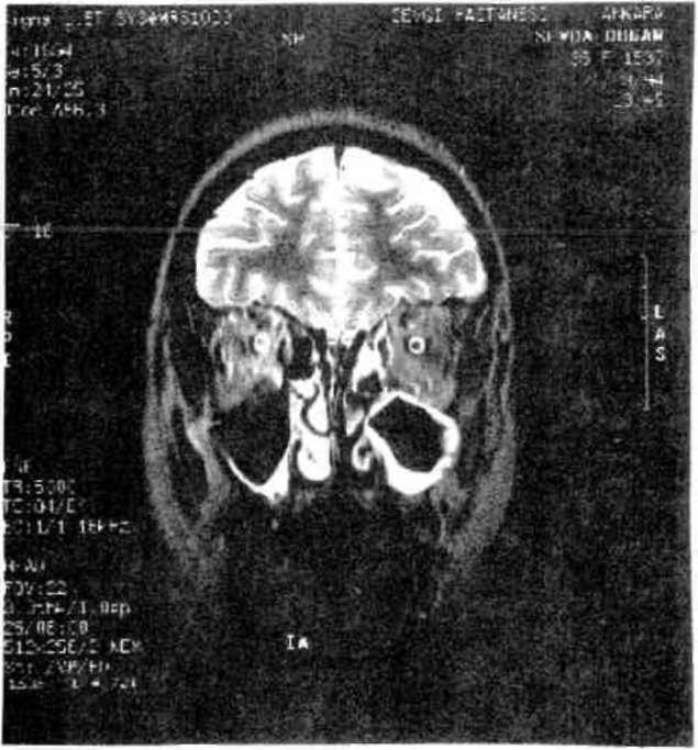 Koronal MRI kesitinde multipl skleroza ait demyeiinize Şekil 5. Aksiyal MRI kesitinde multipl skleroza ait demyeiinize plaklar.