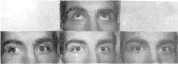 Abdüksiyon yapan gözdeki nistagmus ise, zayıf medial rektusa gelen inervasyonun artmasıyla, Hering kanunu gereği karşı taraf gözün lateral rektusuna gelen uyarımın da fazla olmasına bağlanmıştır (7).