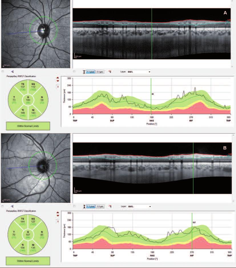 RESİM 2: Retina sinir lifi tabakası ölçüm modunda alınan optik koherens tomografi görüntüsü (A. Polikistik over sendromlu olgu, B. Sağlıklı kontrol grubuna ait olgunun foliküler fazı).