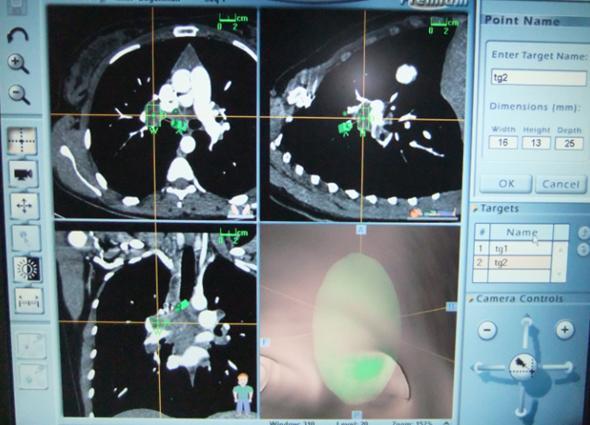 bronkoskopi görüntüsü görülmektedir.