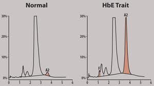 HPLC HbA2 ve HbF kantite etmede en iyi metod.