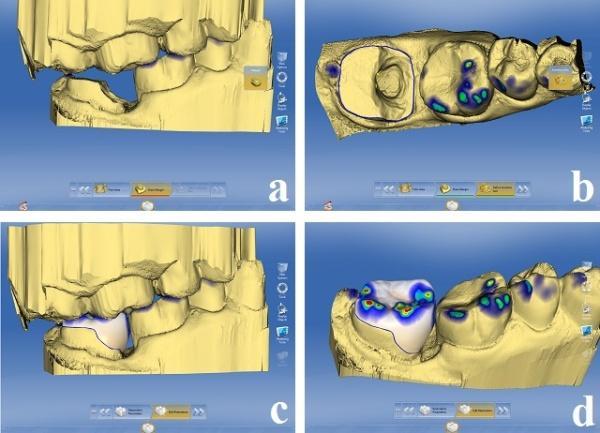 Üç ay takip edilen hastanın klinik ve radyografik değerlendirmesinde restorasyon kenar uyumunun iyi olduğu gözlenmiş ve herhangi bir estetik ya da fonksiyonel yakınmaya rastlanılmamıştır (Resim 3c).