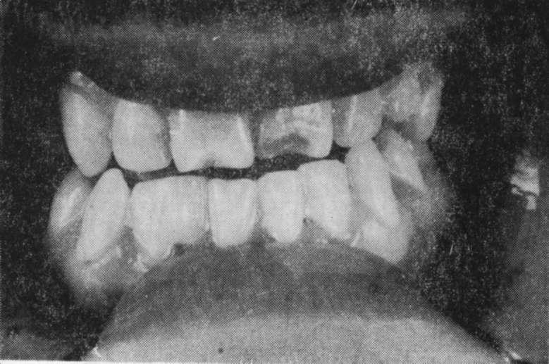 sürnümerer diş arasında fusyon.