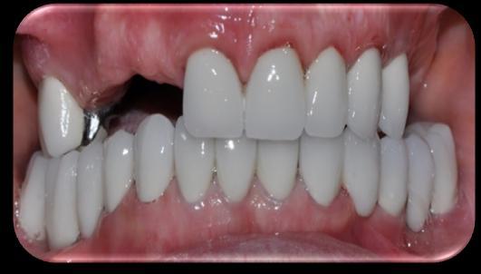 gingival asymmetries(6). There are two aspects to the crown lengthening procedure: Esthetic and functional.