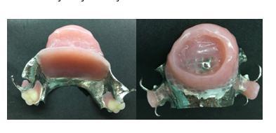 Dicle Dişhekimliği Dergisi / Dental Journal of Dicle RINOSEREBRAL MUKORMIKOZIS Çağatay AKTAŞ ve ark. iskelet alt yapı üretildi.