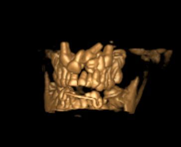 Konik ışınlı bilgisayar tomografi ile gömülü dişlerin pozisyonlarının değerlendirilmesi Resim 14.