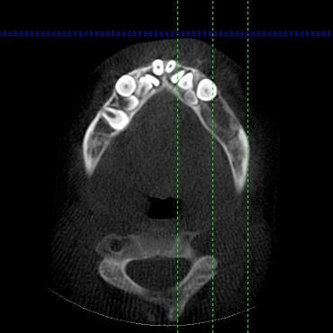 Konik ışınlı bilgisayar tomografi ile aksiyal kesitte üst çenedeki süpernümerer ve gömülü dişlerin görüntüsü Tartışma KKD, iskeletesel ve dental anomalilerle karakterize genetik geçiş gösteren