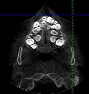 283 KKD li birey üzerinde yaptıkları bir çalışmada, olguların %93,5 tan fazlasında dental anomaliler gözlenirken, %84,3 ten fazlasında iskeletsel anomalilerin gözlendiğini bildirmişlerdir (5).