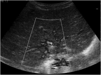 Doppler US, Wilms tümörü olan hastalarda renal ven ve inferiyor vena kava trombozunu (Resim 2), karaciğer kitlesi olan hastalarda kitlenin damarsal yapılarla olan ilişkisini göstermekte önemli rol