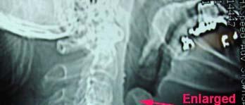 Viral farenjit Akut rinosinüzit