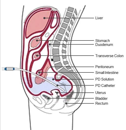 Amaç; Peritoneal kapiller ile periton boşuğundaki diyalizat arasında yarı