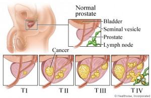 T Kategorisi TX T0 T1 T1a T1b T1c T2 T2a T2b T2c T3 T3a T3b T4 T Kriterleri Primer tümör değerlendirilemiyor Primer tümör bulunamadı Klinik olarak palpe edilemeyen tümör Rezeksiyon materyalinin % 5