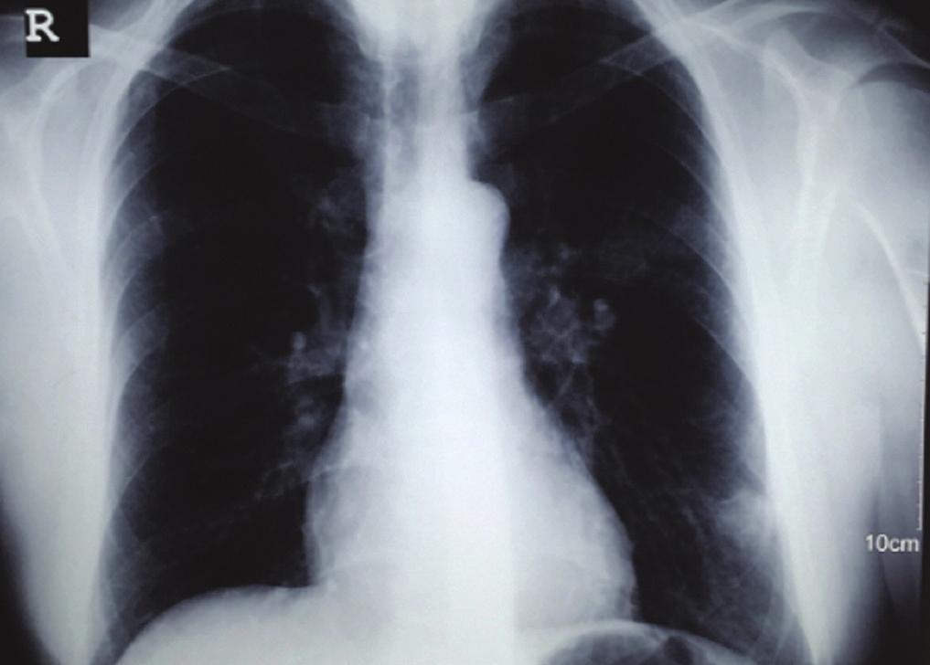 Giriş Tüberküloz (Tbc), gelişmekte olan ülkelerde en önemli halk sağlığı sorunlarından biri olmaya devam etmektedir. En sık akciğerleri tutmakla beraber ekstra pulmoner tutulum da olabilir.