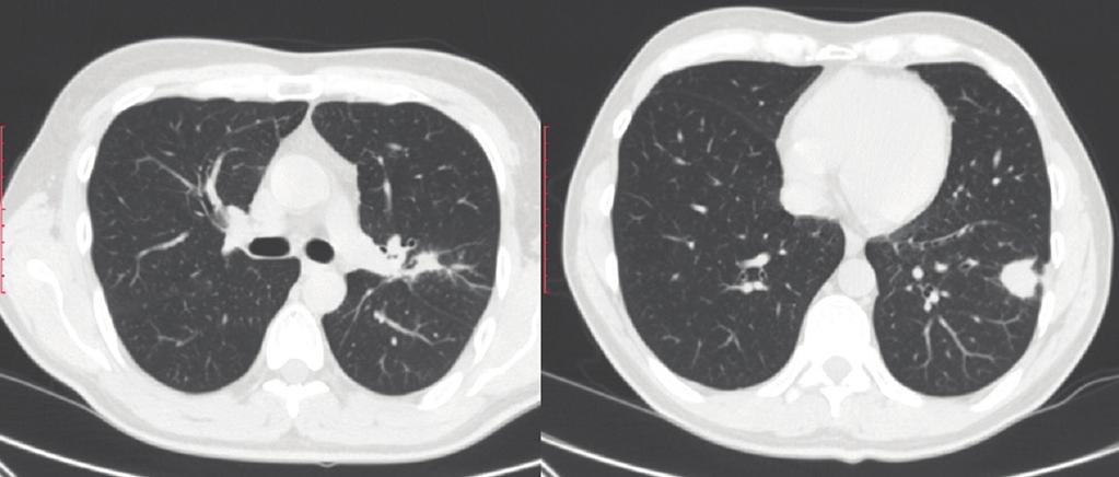 yon izlenmedi. Sol üst lobdan bronş lavajı, sitolojik fırçalama ve sol hiler transbronşiyal iğne aspirasyonu (TBİA) yapıldı.