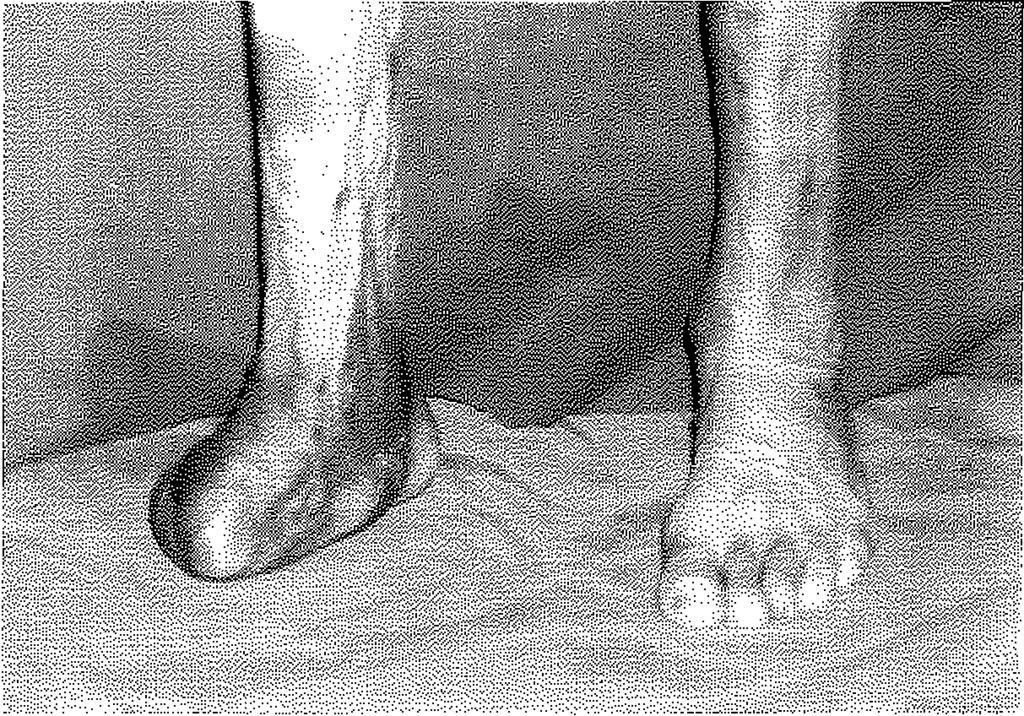 Ameliyat sonrası 4X2500Ü/gün heparin ve antibiyotik profilaksisi uygulandı. Ayak bileği düzeyinde oluşturulan lupun çalıştığı günlük thrill palpasyonları ile kontrol edildi.