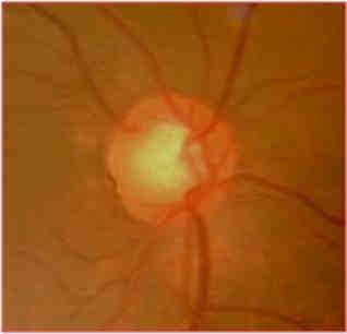 yatay eksende dikey eksene göre daha geniştir (105). Normal gözlerde yatay C/D in dikey C/D e oranı genellikle 1 den büyüktür.
