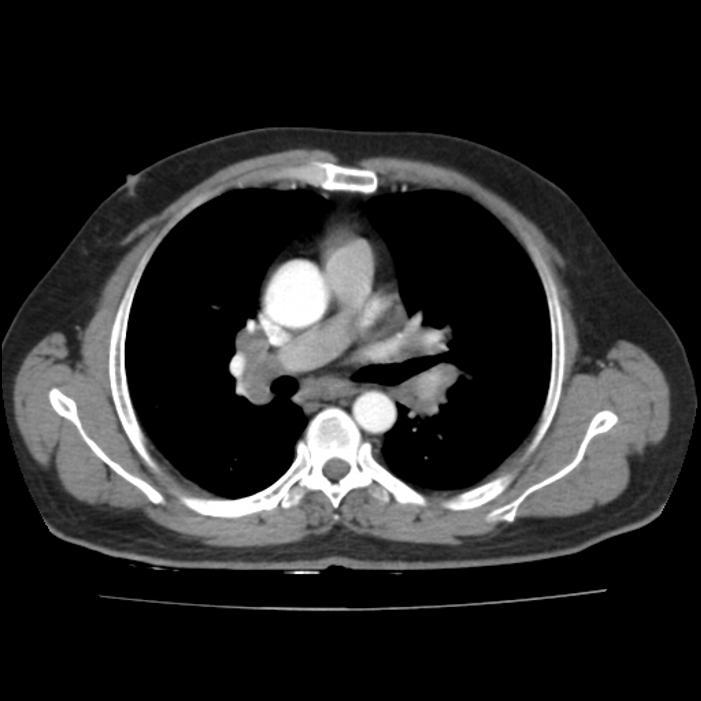 Hastanın çekilen akciğer grafisinde özellikle sağda olmak üzere hiler dolgunluk tespit edildiği için hastaya toraks BT çektirildi.