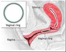 Resim 2.1: Vajinal halka ve vajinadaki pozisyonu Vajinal halkanın olumlu yönleri: Son derece etkilidir. Kullanımı kolaydır çünkü çok düşük doz hormon kullanılır. Geri dönüşlüdür.