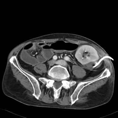 Resim 21: 42 yaşında erkek hastada sağ iliak fossada portal fazda alınan abdominal BT incelemesinde aktif kanamayı gösteren kontrast madde ekstravazasyonu izleniyor.