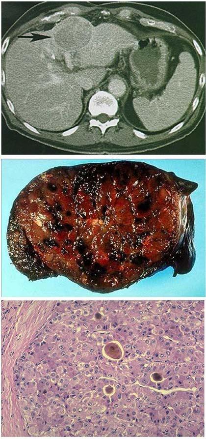 IV-Karaciğer hastalıkları ve transaminaz yüksekliği Alkolik karaciğer hastalığı Toksik hepatit (DILI ) Akut/kronik hepatit Karaciğer sirozu