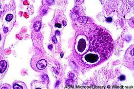 Histopatoloji Doku invaziv hastalık tanısı (Özellikle GIS tutulumu) Kanda CMV testleri
