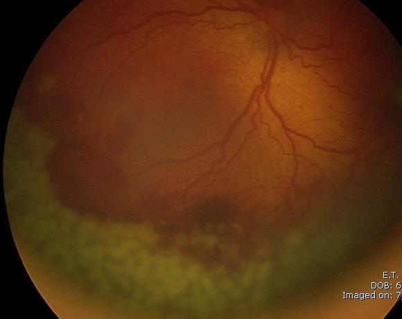 ve yan etkilerde (retinal hasar, atrofik glial skar oluşumu, katarakt riski vb.) azalma ile sağlamıştır [61-63]. Şekil 2.4.