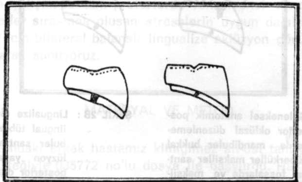 Cumhur ALTINTAŞ, O. Tuğrul ALTAY, Aytokin BİLGE 3 Posterior mandibuler dişlerde hangi materyalden yapıldığına bakılmaksızın selektif mölleme yapılır.
