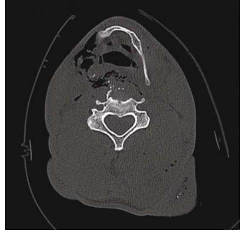 Obstruction Secondary to Gunshot Injury