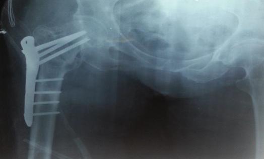 Subtrokanterik kırık olup psodoartroz tanısı alan 3 hastadan 2 sine implant değiştirilmeden psodoartroz cerrahisi ve iliak otojen greft uygulandı bu hastaların takiplerinde operasyon sonrası ortalama