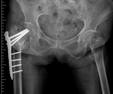 Ay kontrolünde medial korteks devamlılığında bozulma görülmesi nedeniyle implant çıkarımı+iliak otojen greftleme+proksimal femoral çivileme yöntemiyle rekonstriksiyon yapıldı.