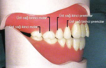 1: Üst posterior diģlerin uzun eksenlerinin eğimi DiĢ diziminde oklüzogingival uzunluğa, birinci premolar diģ seçimine de önem vermek gerekir.