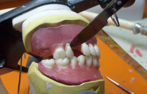 Ġkinci premoların bukkal tüberkülünün tepe noktasının alt birinci molar ile ikinci premolar arasında olmasına dikkat