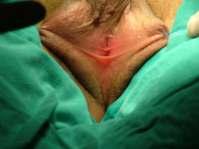Erkek Psödohermafrotidizm 5 Alfa Redüktaz Eksikliği Tip 2 genindeki mutasyon Doğumdaki ciddi hipospadiak