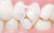 revizyon arasında tamamlanır Genellikle tedavi sonunda D E Görsel A. B Döndürülecek dişlere iki yönden buton takılmıştır. Butonlar ile birlikte elastik kullanımı mevcuttur.
