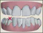 Maxillar dişlerin mandibular dişlerle oklüzal ilişkisinde daha bukkal de yada lingual de olması durumuna çapraz kapanış diyoruz.