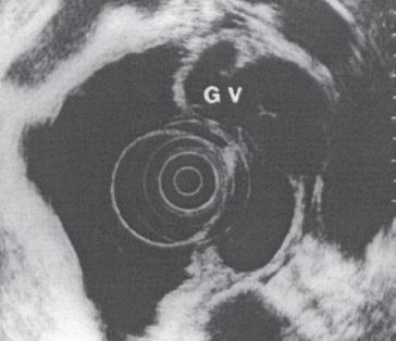 6 özofagogastroskopi gibi iş görür, fakat varis derecelendirilmesinde rolü yoktur. Buna karşın gastrik varislerin tespitinde özofagogastroskopiden üstündür.