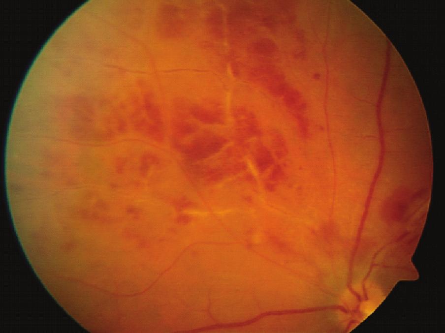Bu çalışmada hastaların, %51 inde retinit, %60 inda panüveit, %89 unda retinal vaskülit tespit etmişlerdir. Tugal-Tutkun ve ark.