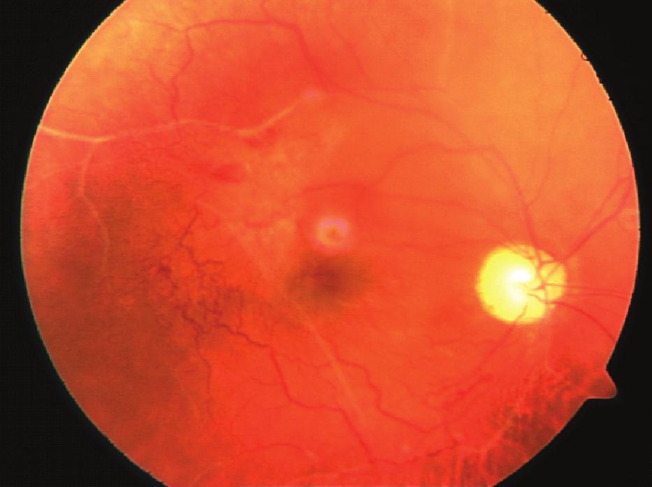 Retinal vaskülit, retinal kan damarlarının inflamasyonu ve nekrozu ile seyreden klinik tablodur. Retinal vaskülitler, arter, ven ve kapiller sistemi ayrı ayrı veya birlikte tutabilir.