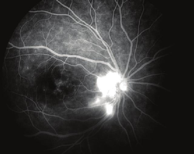 134 Behçet Hastalığı ve Retinal Vaskülitler Resim 4: Disk neovaskülerizasyonu, maküler ödem. (Prof. Dr. Sibel Kadayıfçılar ın izni ile).