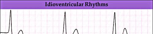 İdiyoventriküler ritim; QRS kompleksi 0.
