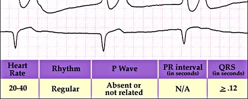 Algoritmi Agonal ritim; Bradikardi Kalp hızı < 60 Yavaş, çok geniş ve düzensiz komplekslerin olduğu bir ritimdir Genellikle ventriküler kontraksiyon eşlik etmez Asistoli Mönitörize et gözle hayır