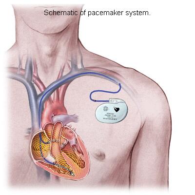 15 Elektronik Pacemaker Çok düşük kalp