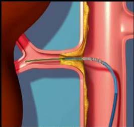 2-Renal arter stenozu %10 Etyoloji: kesin nedeni bulunamaz Rejeksiyon Aterom plağı Prezervasyon hasarı Graft arter travması Kötü