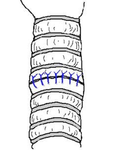 Ön duvarın anastomozunda sütürler, hepsi tamamlanana kadar bağlanmaz. Böylece sütürlerin tam kat geçirilmesi gözlenmiş olunur (Resim 6A-B).