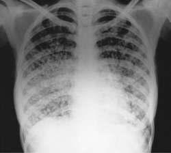 Akciğer Grafisi Tüberküloz Sarkoidoz Sistemik mantar enfeksiyonu Malignite