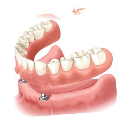 Titanyum Top Abutment Sistemi Hastanın